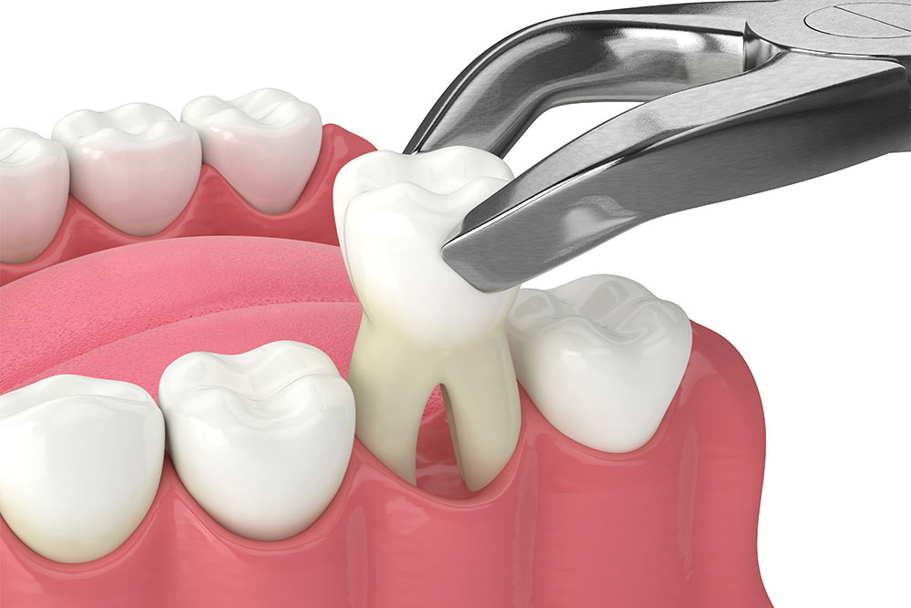 3d render of lower jaw with tooth extracted by dental forceps