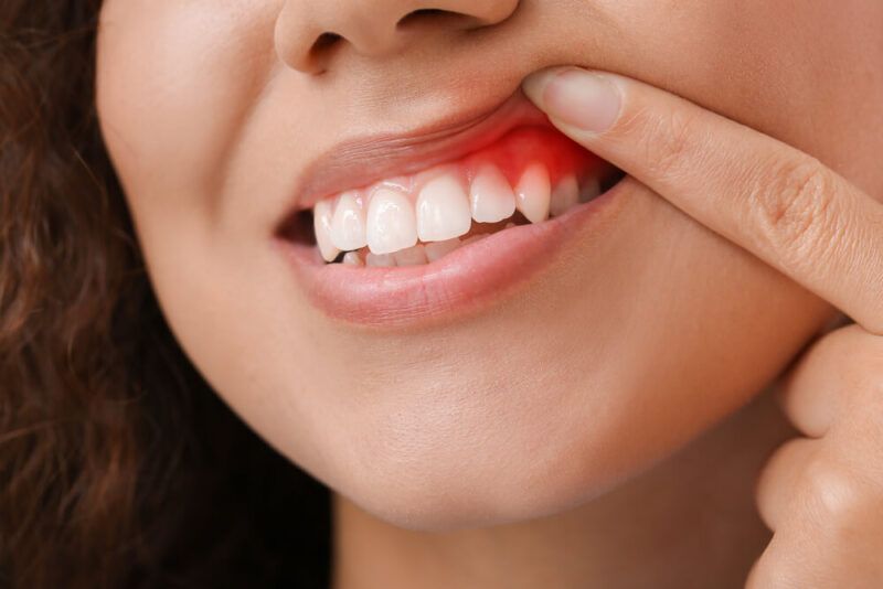 Woman pulling her lip down to show her gum line