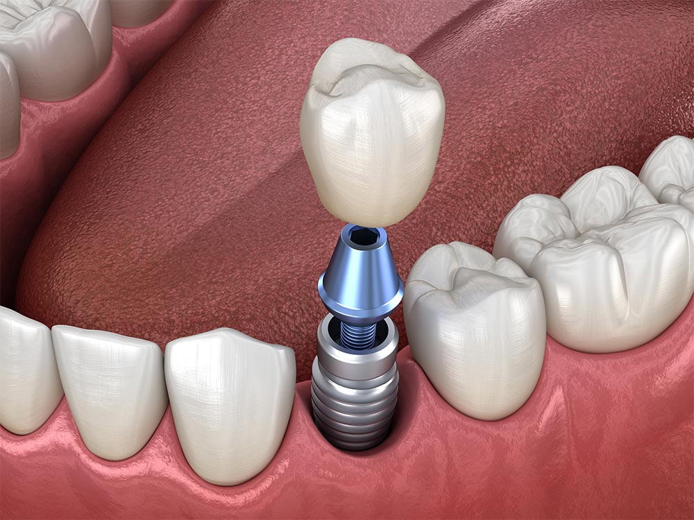 3D illustration of a dental implant topped with a crown