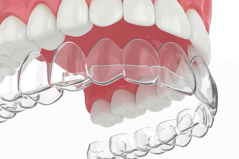 3d render of upper jaw with invisalign removable retainer
