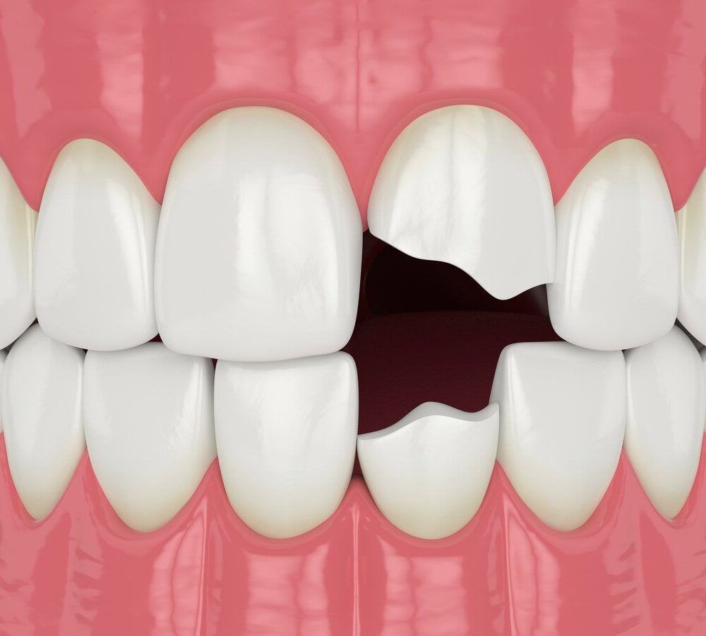 3D illustration of front teeth with one chipped tooth