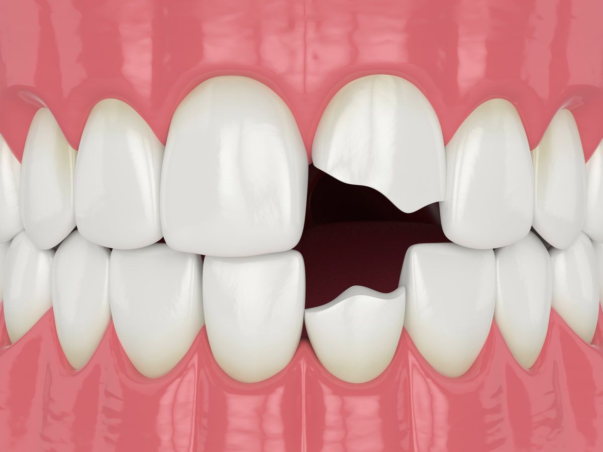 Illustration of front teeth with chipped and broken edges