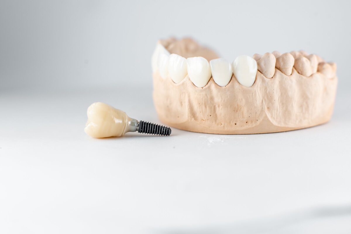 Dental implant crown beside a plaster model of teeth