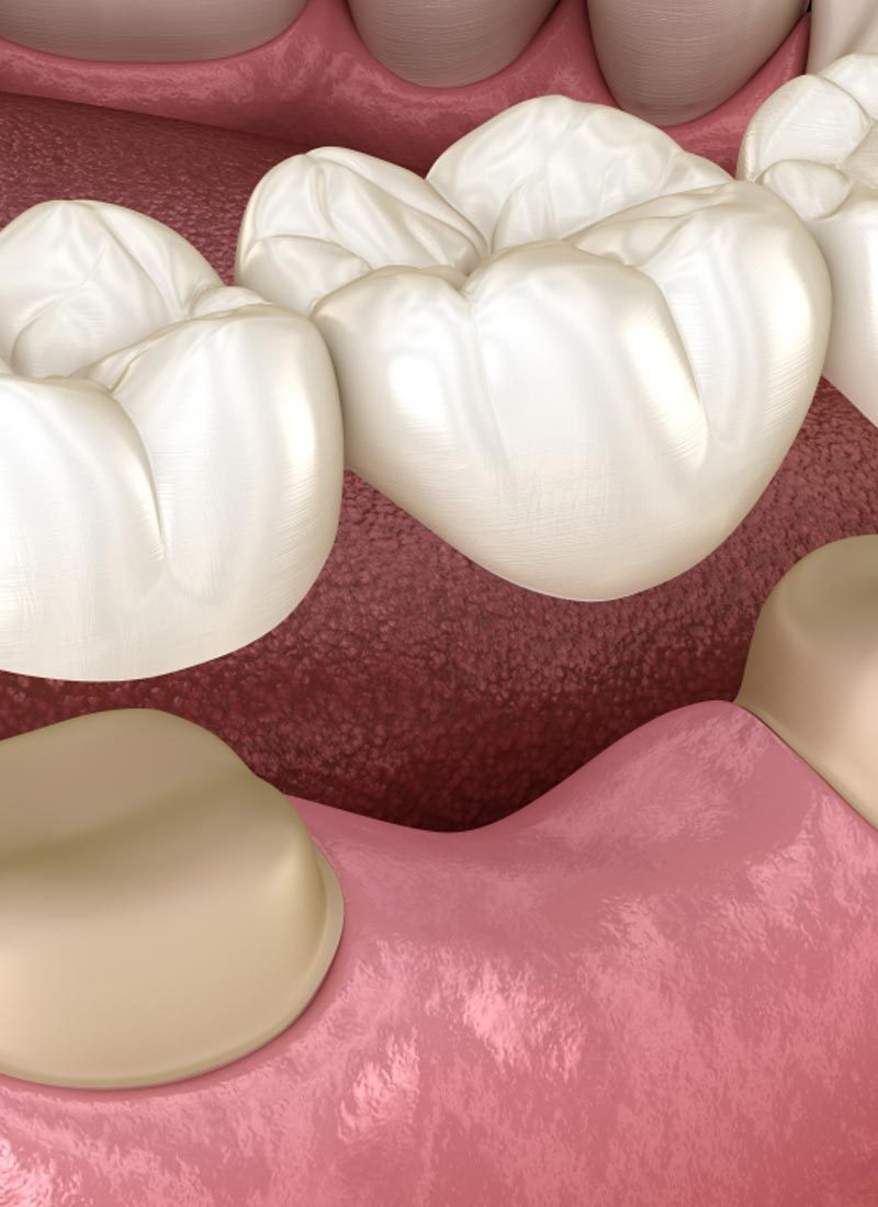 Dental bridge of 3 teeth over molar and premolar