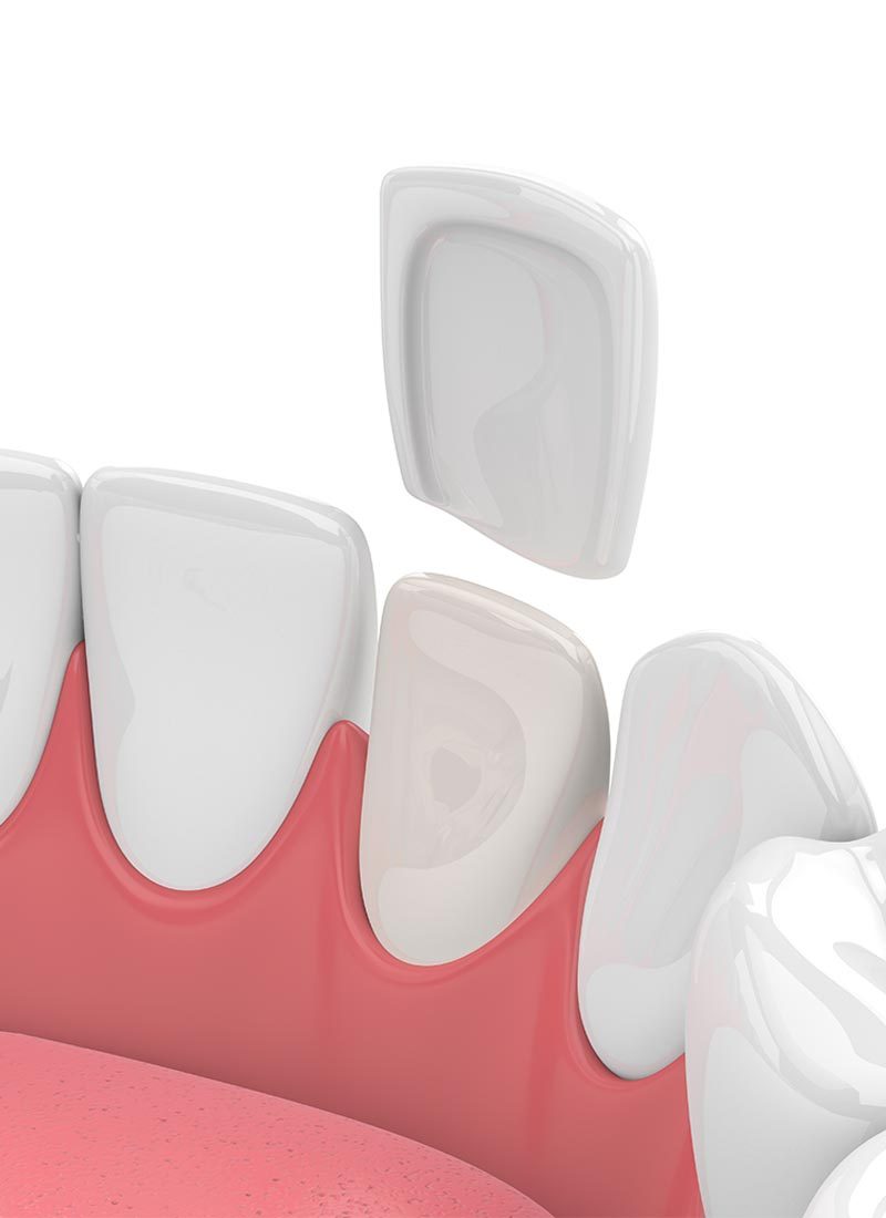 A 3D representation of a tooth veneer being installed
