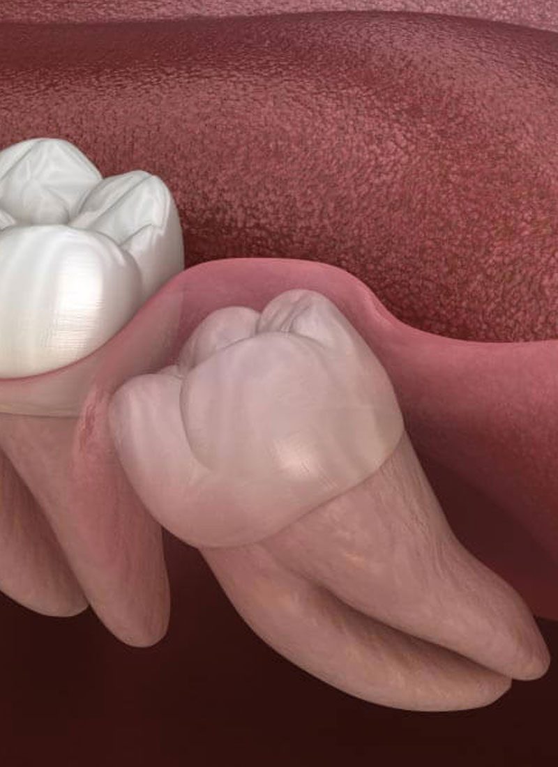 Wisdom teeth HP