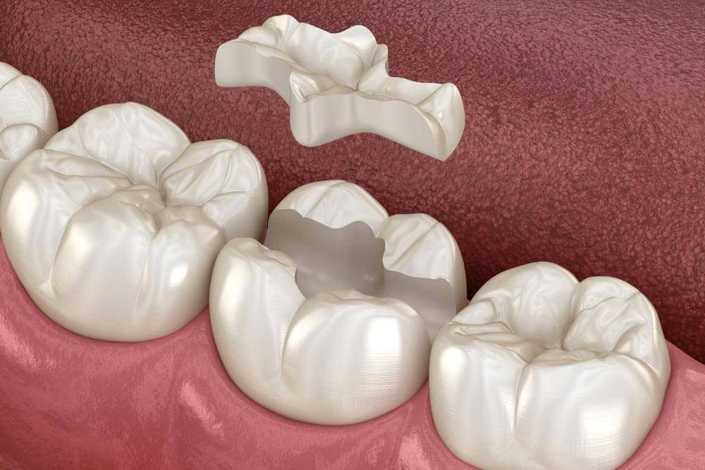Inlay ceramic crown fixation over tooth