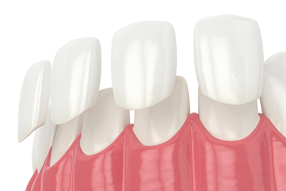 3d render of teeth with veneers